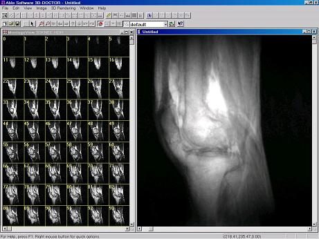 Image Plane Fusion of MRI Image