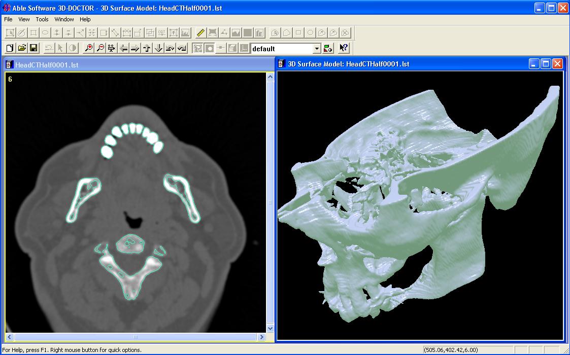 3D Pelvis Model